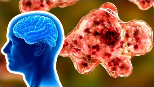 What are The Main Symptoms of 'Brain-Eating' Amoeba?