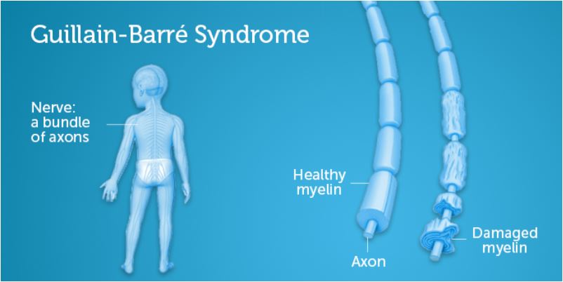 What are The Symptoms of Guillain-Barre Syndrome? - What Is | What Is ...